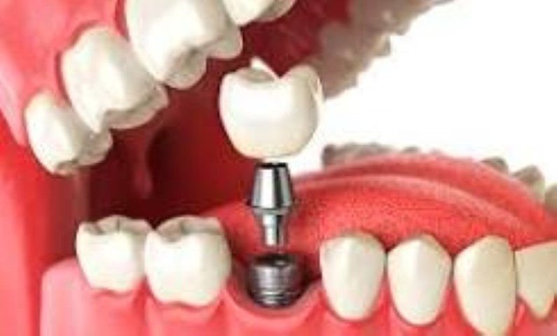Você sabe o que é e qual a importância do implante dentário?